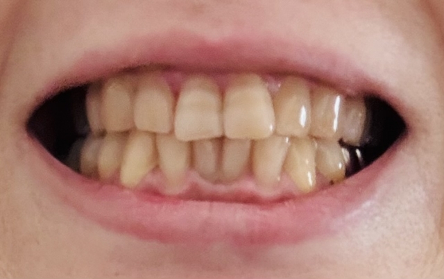 テトラサイクリン歯